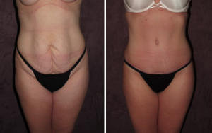 Tummy Tuck Austin