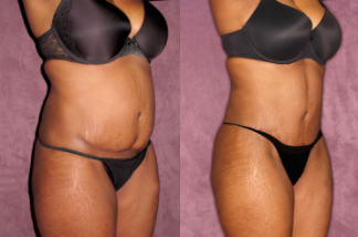 Improve Your Results With Revision Tummy Tuck Surgery - Houston, Texas