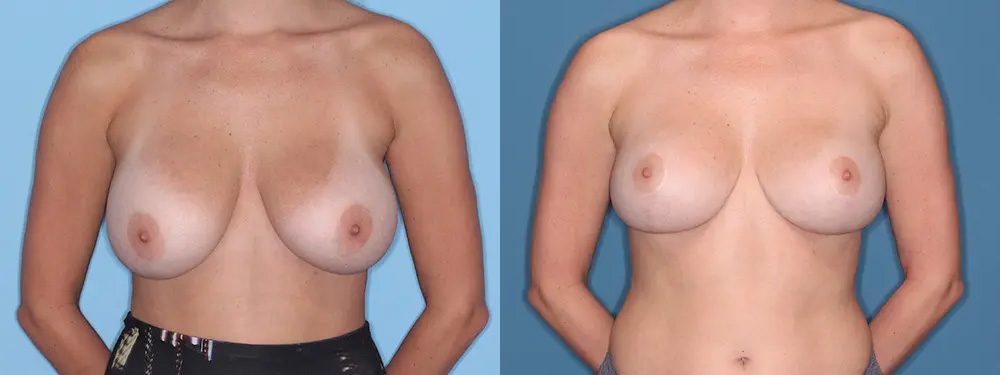 Breast Lift Patient Results