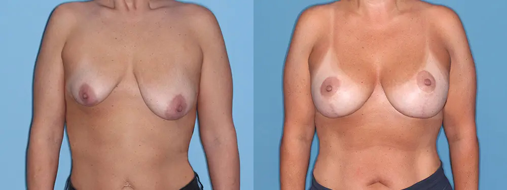 Breast Lift Patient Results 2