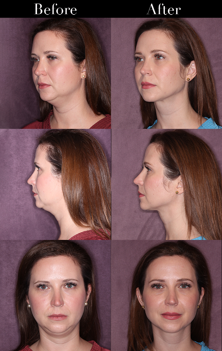 Get a Chiseled Face With Facial Liposuction