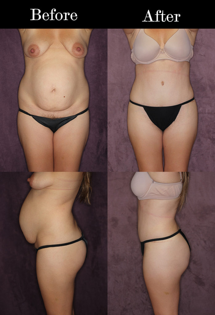 How to Achieve a Brazilian Butt Lift with Shapewear and Not