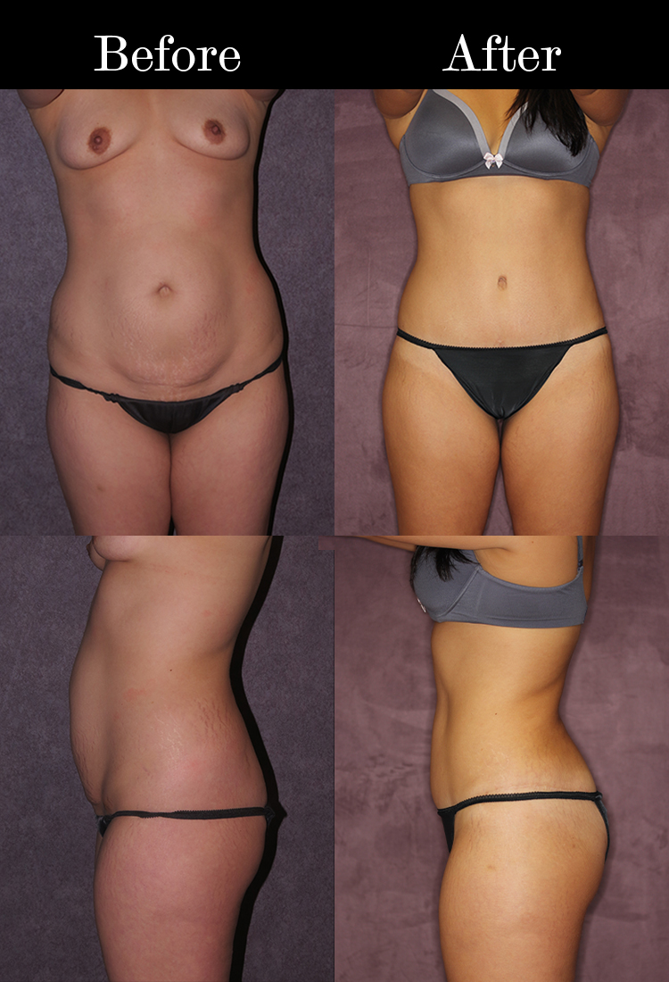 Tummy Tuck Scars: Types, Healing Process, and How To Improve