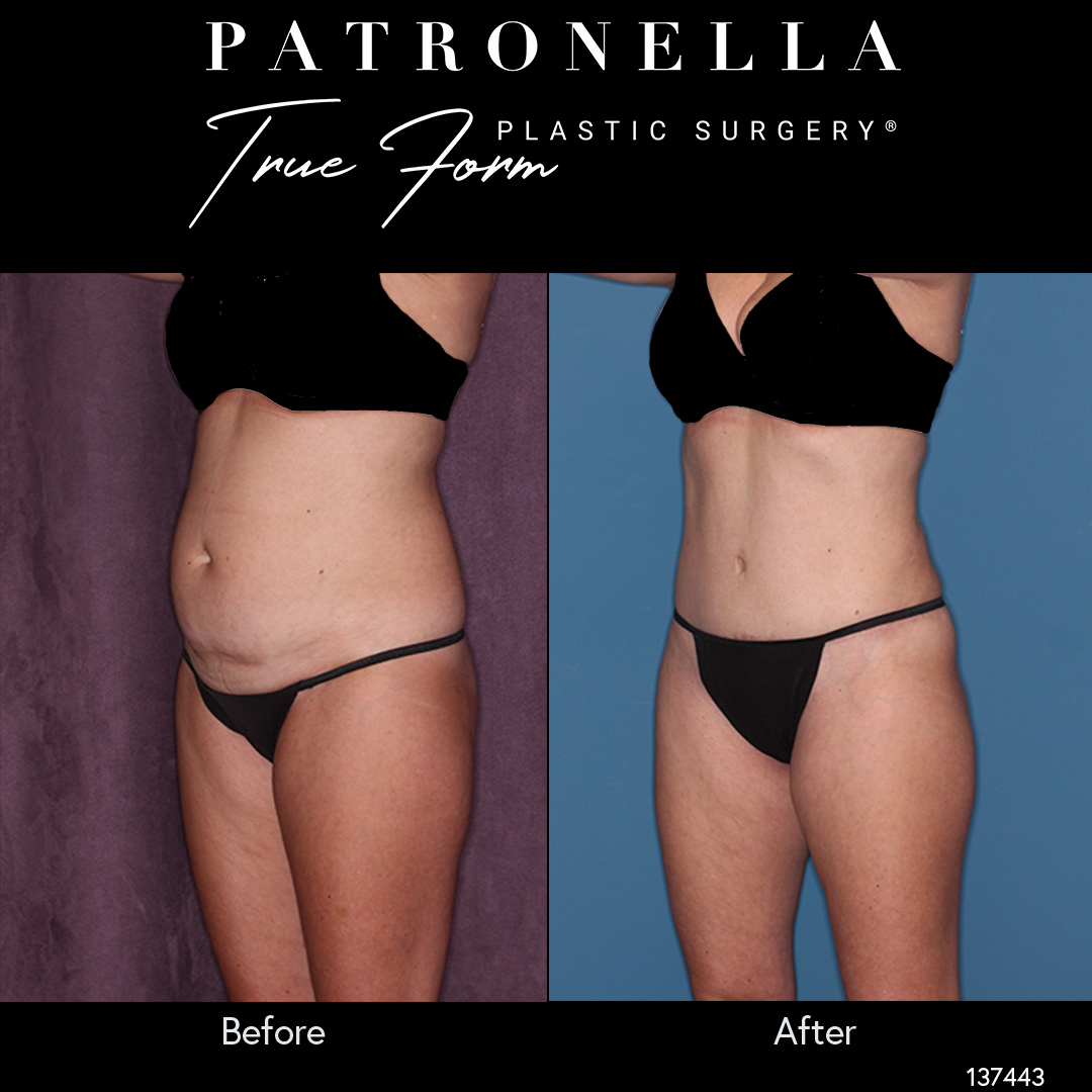 Brazilian Butt Lift Surgery: Dr. Patronella's Approach - Houston, Texas