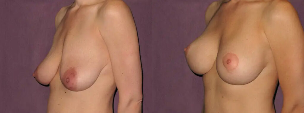 Breast Lift before and after surgery photo