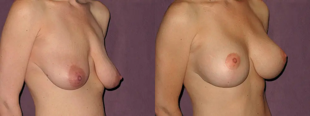 Before and after breast lift performed by Houston's Dr. Patronella.