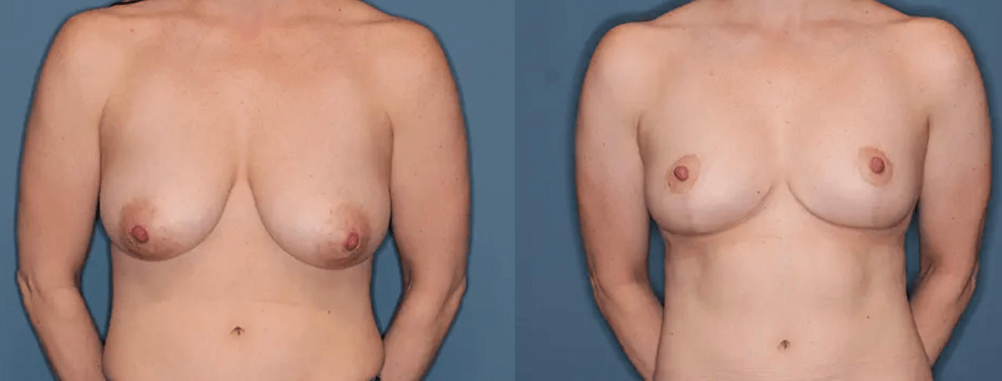 Before and after patient results