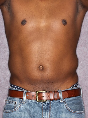 Liposuction for Men Houston TX  Male Liposuction – Houston Lipo
