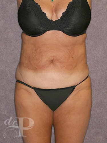 Tummy Tuck - Corrective/Revision Before and After Results - Houston, TX