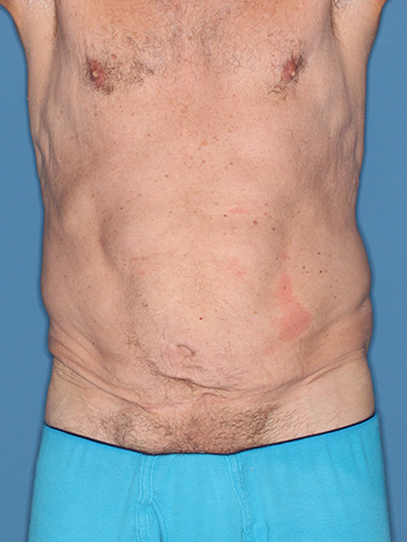 True Form Tummy Tuck® for Men Before and After Results - Houston, TX